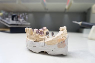Diş implantı olan insan çenesinin alçı taşı modeli