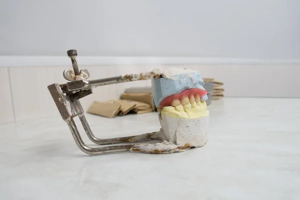 Wax Preparations Removable Dentures Plaster Mode — Stock Photo, Image