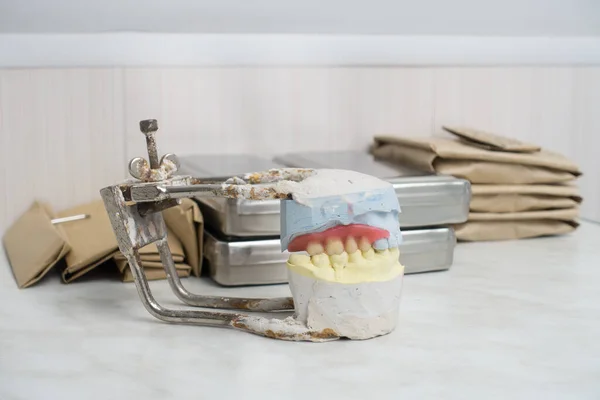 Wax Preparations Removable Dentures Plaster Mode — Stock Photo, Image