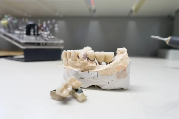 Modelo Gesso Mandíbula Humana Com Implantes Dentários — Fotografia de Stock