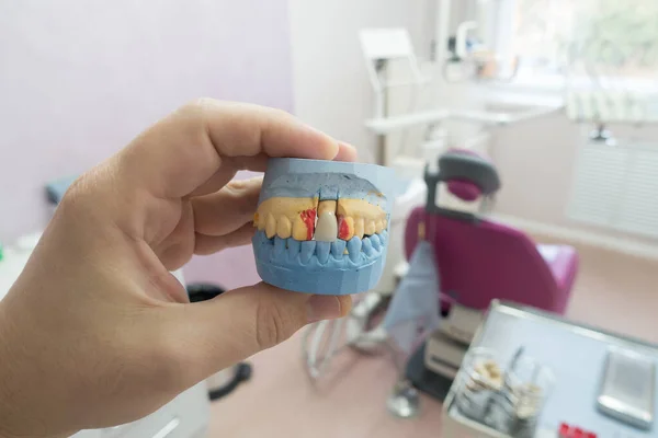 dental ceramic metal crowns on a plaster model in the doctors hand