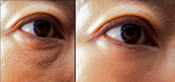 Tedavi öncesi ve sonrası gözlerinde morluklar olan Asyalı kadın gözleri..