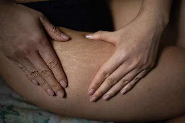 Τεντώστε Σημάδια Στο Δέρμα Στους Γοφούς Ενός Κοριτσιού — Φωτογραφία Αρχείου