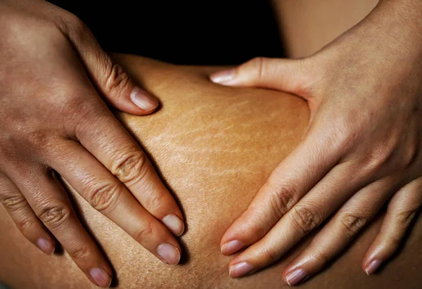 Terhességi Csíkok Bőrön Sebhelyek Testen Terhességi Csíkok Lábon Cellulit — Stock Fotó