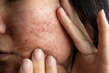 Lazer tedavisinden sonra yüz derisini kapat.