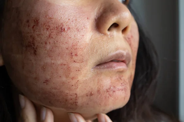 Close-up Skin On Face After Laser Treatment.