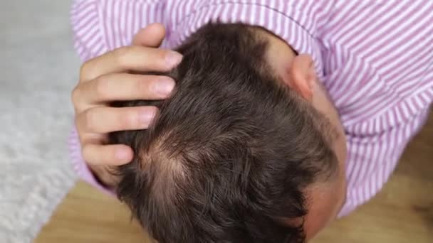 Alopecia Humana Perda Cabelo Homem Adulto Mão Apontando Sua Cabeça — Vídeo de Stock