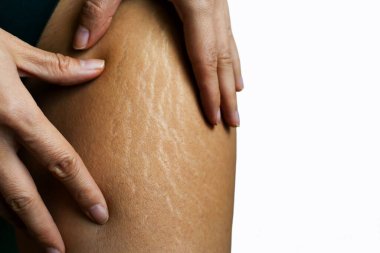Close up female legs with stretch marks clipart