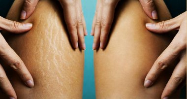 Image compare before and after Woman buttocks with stretch marks removal treatment, real people clipart