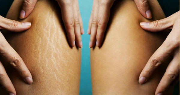 Image Compare Woman Buttocks Stretch Marks Removal Treatment Real People — Stock Photo, Image