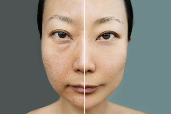 Cilt Gençleştirme Konsepti Estetik Ameliyattan Önce Sonra Asyalı Kadınlar Için — Stok fotoğraf