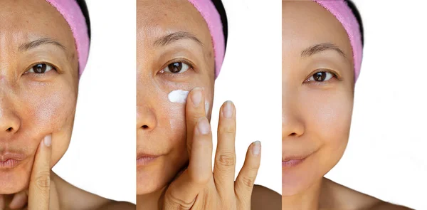 Koncept Omlazování Kůže Před Kosmetické Operaci Bělící Krém Pro Asijské — Stock fotografie