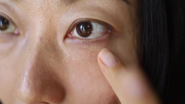 Asijské Unavený Žena Oči Vaky Pod Očima Zavřít — Stock video
