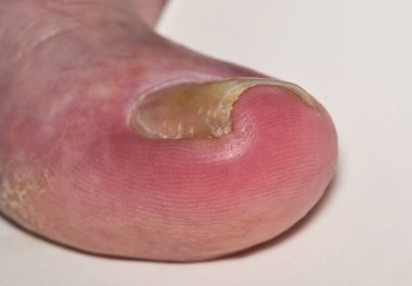 Kafkas baş parmağı Hallux 'ta yetişmiş ayak tırnağı onyelikokriptosu, mantar enfeksiyonu tinea unguium' dan kaynaklanıyor. Makro açılı görünüm beyaz arkaplanda izole edildi.
