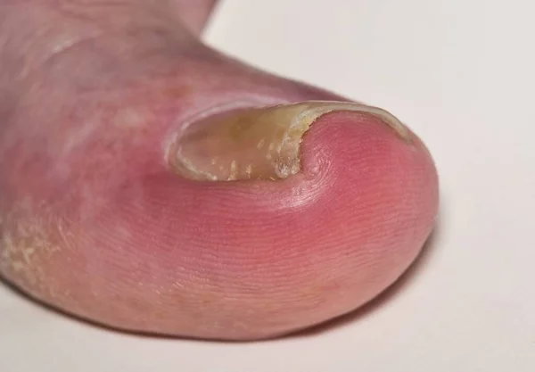 Ingrown Toenail Onychocryptosis Caucasian Big Toe Hallux Caused Fungal Infection — Stock Photo, Image