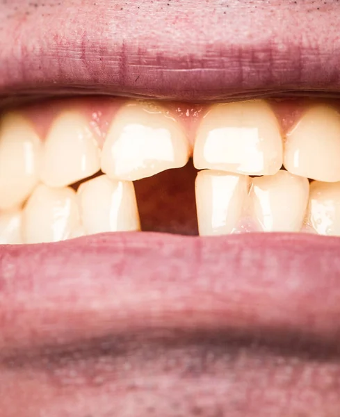 Dentes amarelos. Mau estado dentário, sem dentes, sem flúor, erosão dentária. Dentes amarelos. Homem sem um dente da frente. Sem dentes. Sorria homens com um dente dianteiro perdido, dor de dente — Fotografia de Stock