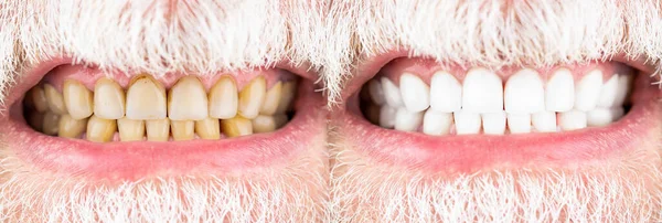 Κοντινό πλάνο των δοντιών ενός χαμογελαστού άντρα πριν και μετά τη λεύκανση. Ανδρικά δόντια πριν και μετά τη λεύκανση, οδοντιατρική φροντίδα του στόματος, στοματολογία. Χαμογελώντας άνθρωπος πριν και μετά λεύκανση δοντιών διαδικασία, closeup — Φωτογραφία Αρχείου