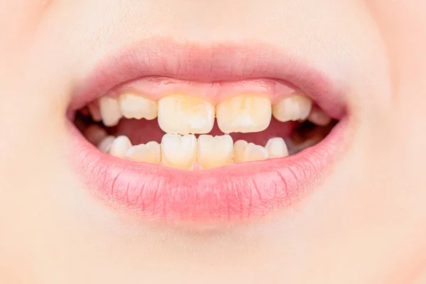 Primo piano di dentiere per bambini malsani. Paziente bambino bocca aperta che mostra carie denti carie. Bambino con i denti cattivi. Ritratto ragazzo con i denti cattivi. Bambino sorridere e mostrare il suo dente affollamento — Foto Stock