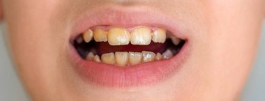 Tedavi öncesi sarı dişler ve diş beyazlatma, diş tacları. Diş hekimliği yakın çekim. Kötü dişli çocuk. Çarpık sarı dişli bir adamın ağzı..