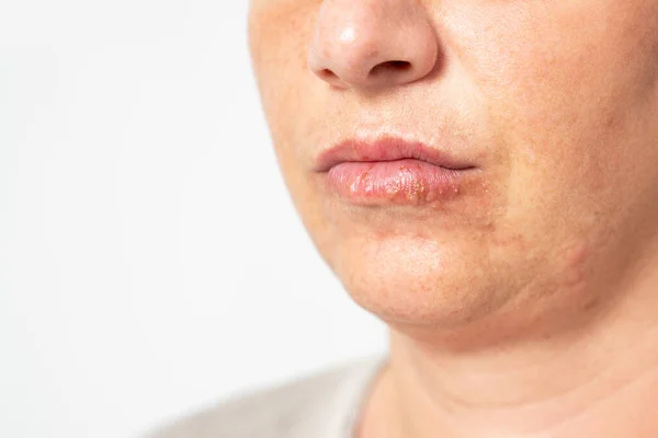Молода жінка страждає від герпесу на губах. Концепція проблеми зі шкірою, алергія та дерматологія . — стокове фото