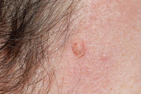 Yüzünde Dermatolojik Oluşum Deride Fibroma Dermatolojisi Problemi Papilloma Dermatozunu Kapat — Stok fotoğraf