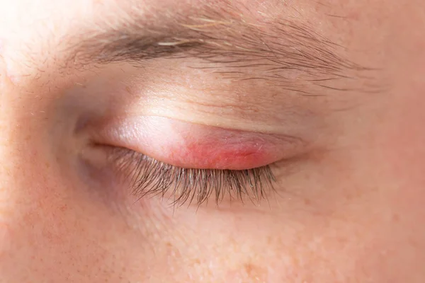 Swelling Eye Swollen Upper Lid Close — 图库照片