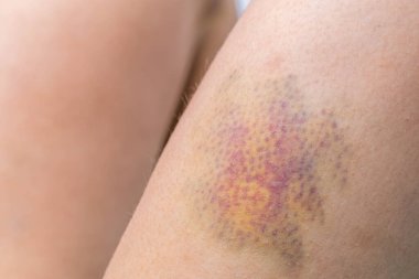 Bacağında hematom var. Büyük hematom, yakın çekim..