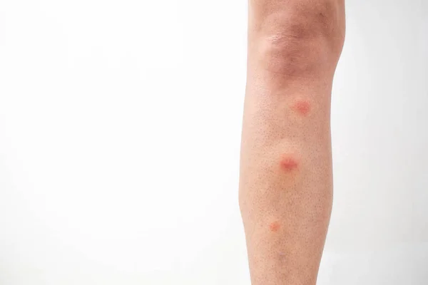 Komar Gryzie Nogę Mosquito Gryzie Strzał Bliska — Zdjęcie stockowe