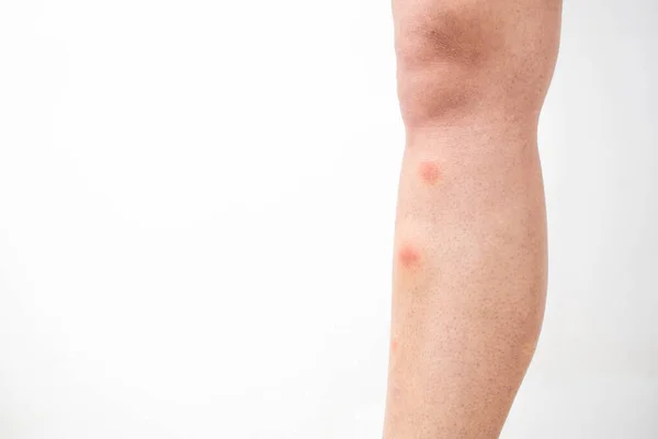 Mosquito bites on the leg. Mosquito bites close up shot.