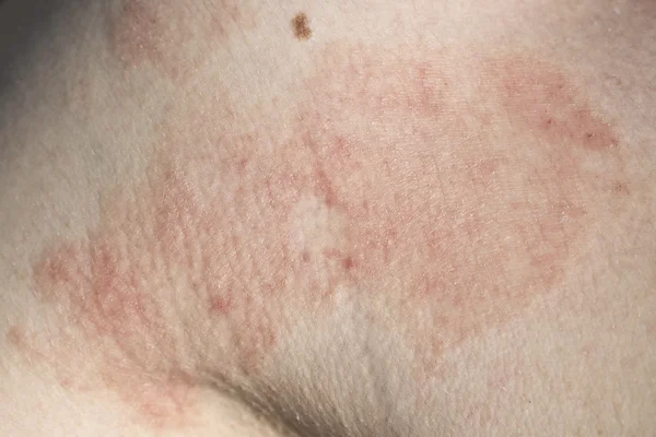 Dermatitis cutánea —  Fotos de Stock