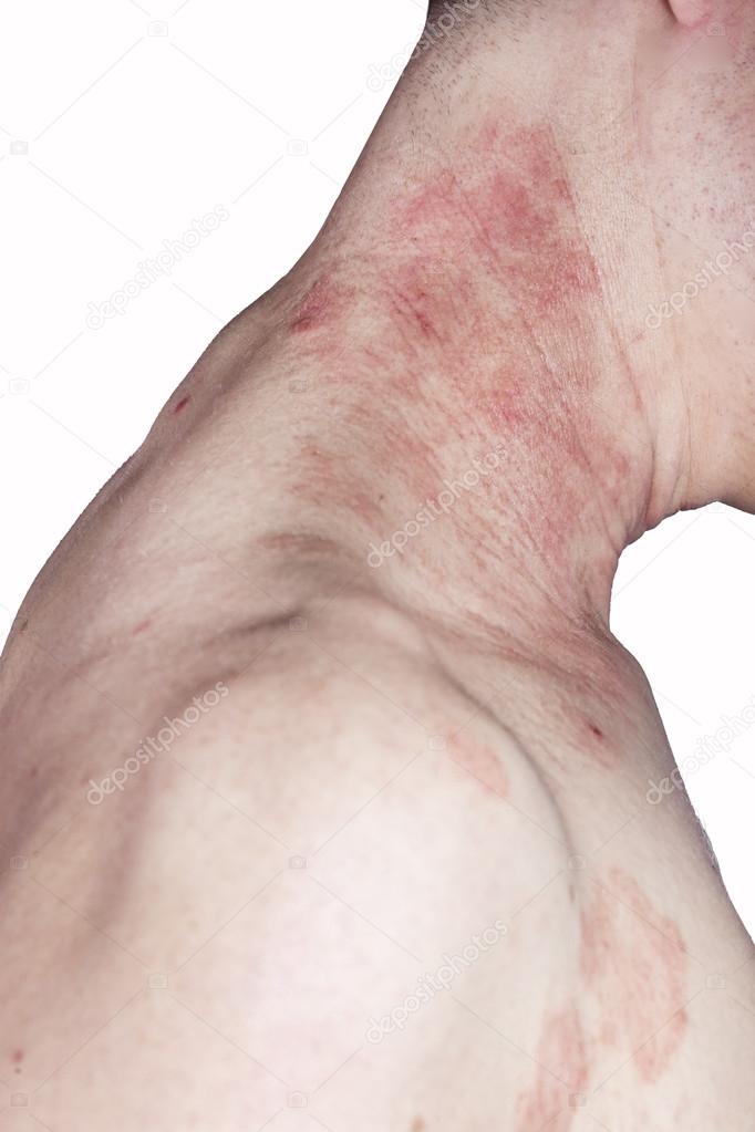 Skin dermatitis