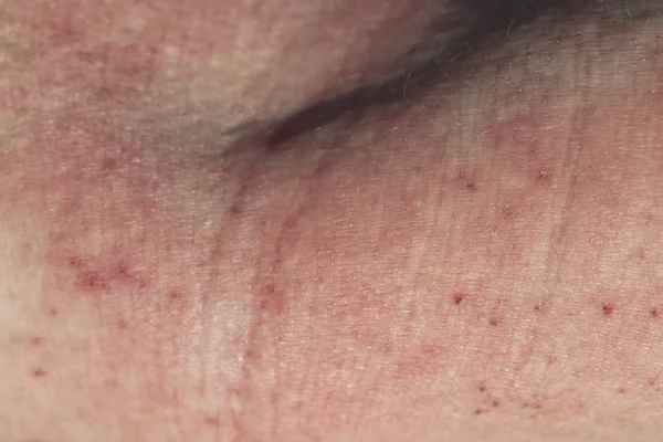 Dermatitis cutánea — Foto de Stock