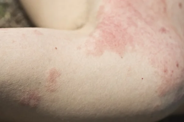 Skin dermatitis — Stock Photo, Image