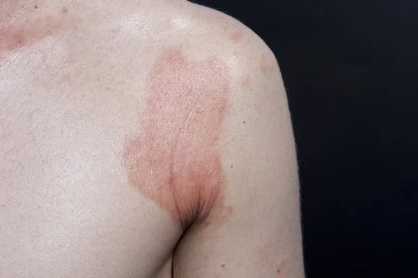 Bőr bőrgyulladást — Stock Fotó