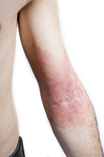 Huid dermatitis — Stockfoto