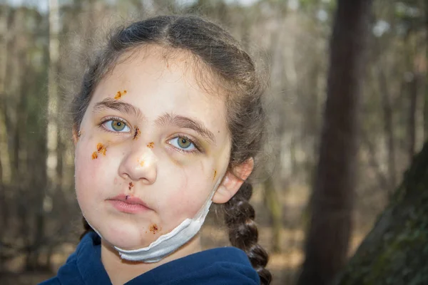 Spring Afternoon Forest Girl Face All Scratched Bruised Dog Bite Zdjęcia Stockowe bez tantiem