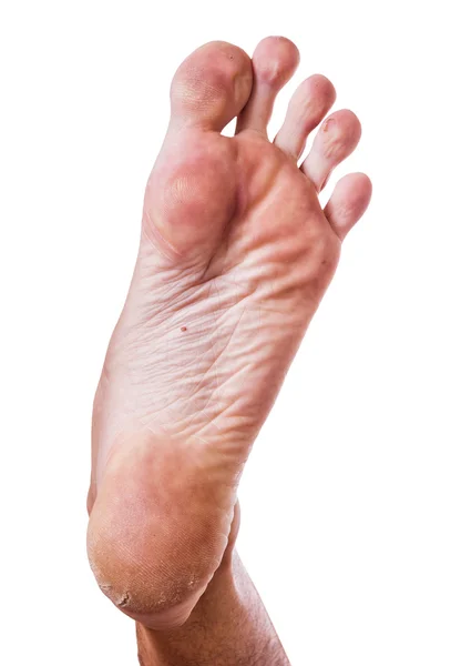 Skin on heel — Stock Photo, Image