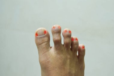 Ayak parmakları ağrısı, ayak tırnakları ve ayak mantarı. Sağlık sorunları kavramı