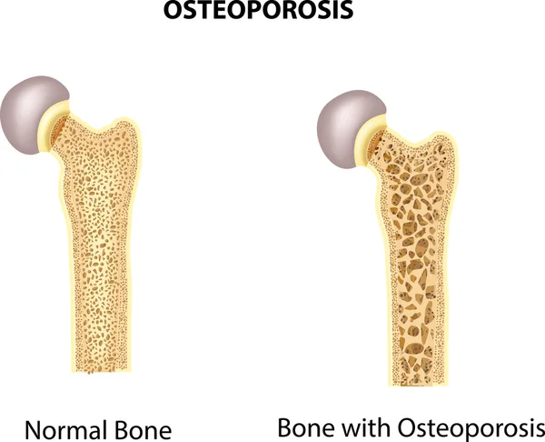 Ilustração do osso do quadril. osso e osso normais com osteoporose — Vetor de Stock