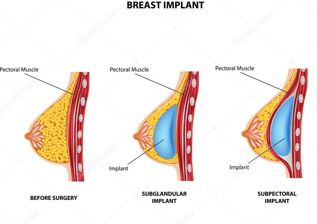 Illustration of Plastic surgery of breast implant