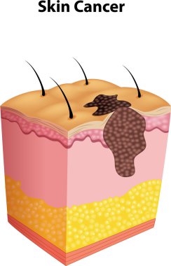 Illustration of skin cancer clipart