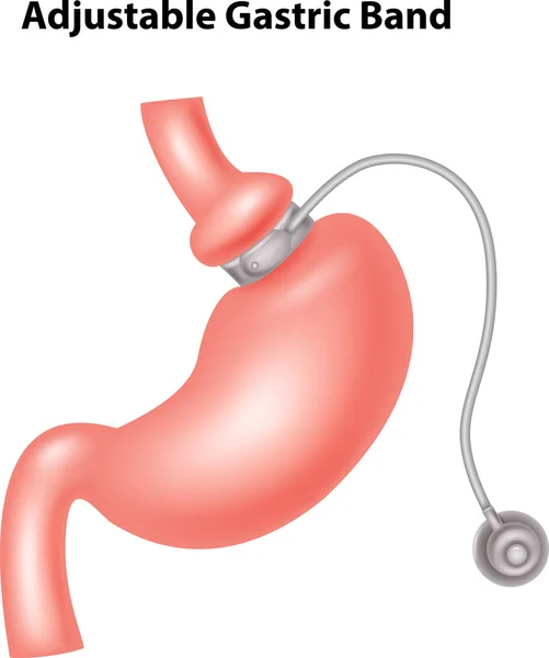 Illustrazione della fascia gastrica regolabile — Vettoriale Stock