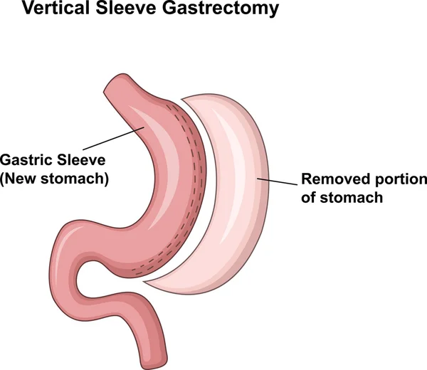 Illustration av vertikal Sleeve Gastrectomy (Vsg) — Stock vektor