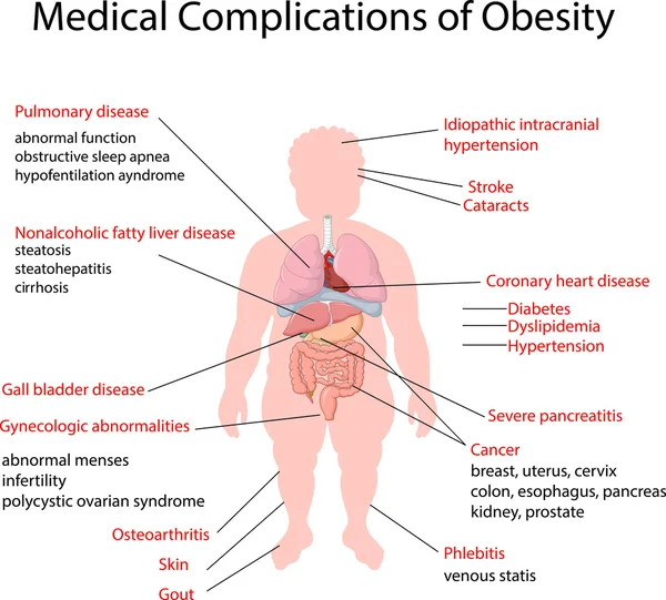 Illusztráció: orvosi komplikáció, az elhízás — Stock Vector