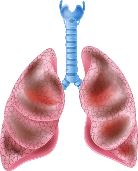 Illustrazione dei polmoni dei fumatori — Vettoriale Stock