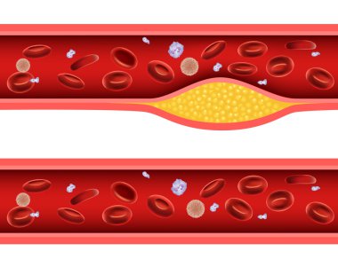 Illustration of Artery blocked with bad cholesterol anatomy clipart
