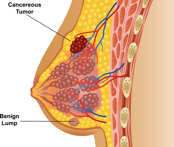 Ilustração do tumor de mama canceroso —  Vetores de Stock