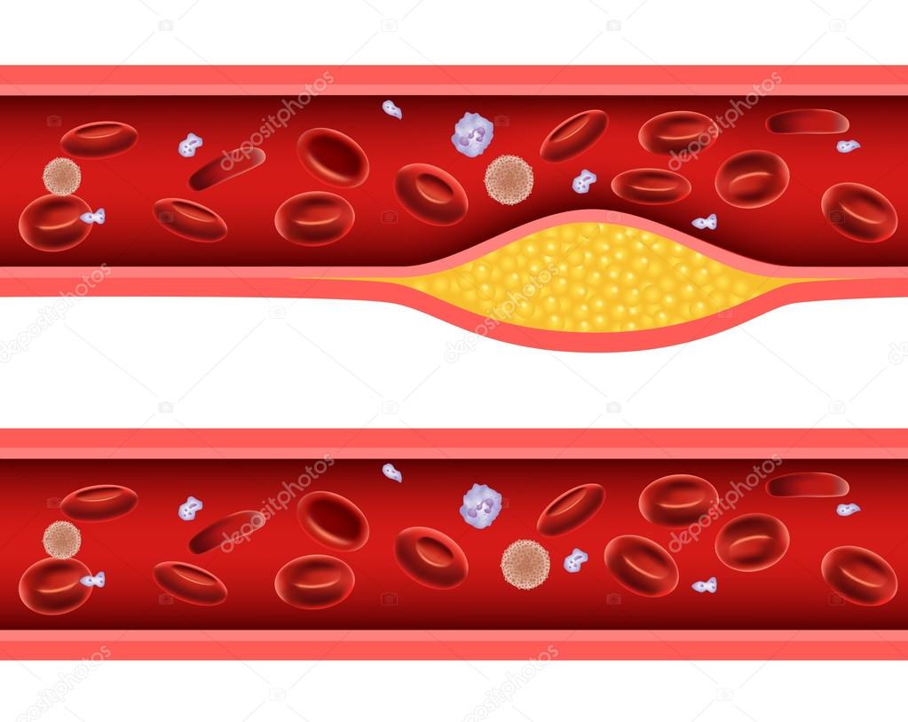 Illustration of Artery blocked with bad cholesterol anatomy