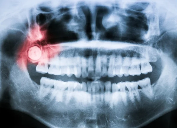 Closeup x-ray of impacted wisdom tooth — Stock Photo, Image