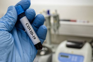 Coronavirus testi. Bir kan örneğinde COVID-19 için antikorların tespiti.